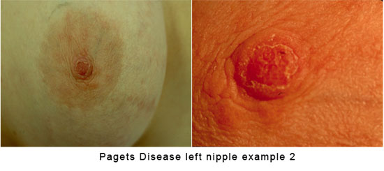 Pagets Disease Left Nipple