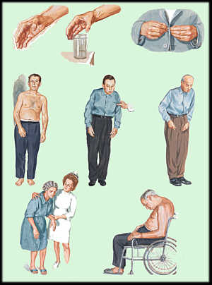 Parkinson Disease